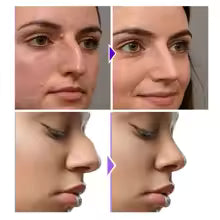 NoseLift™ – Safe, Non-Surgical Nose Sculptor